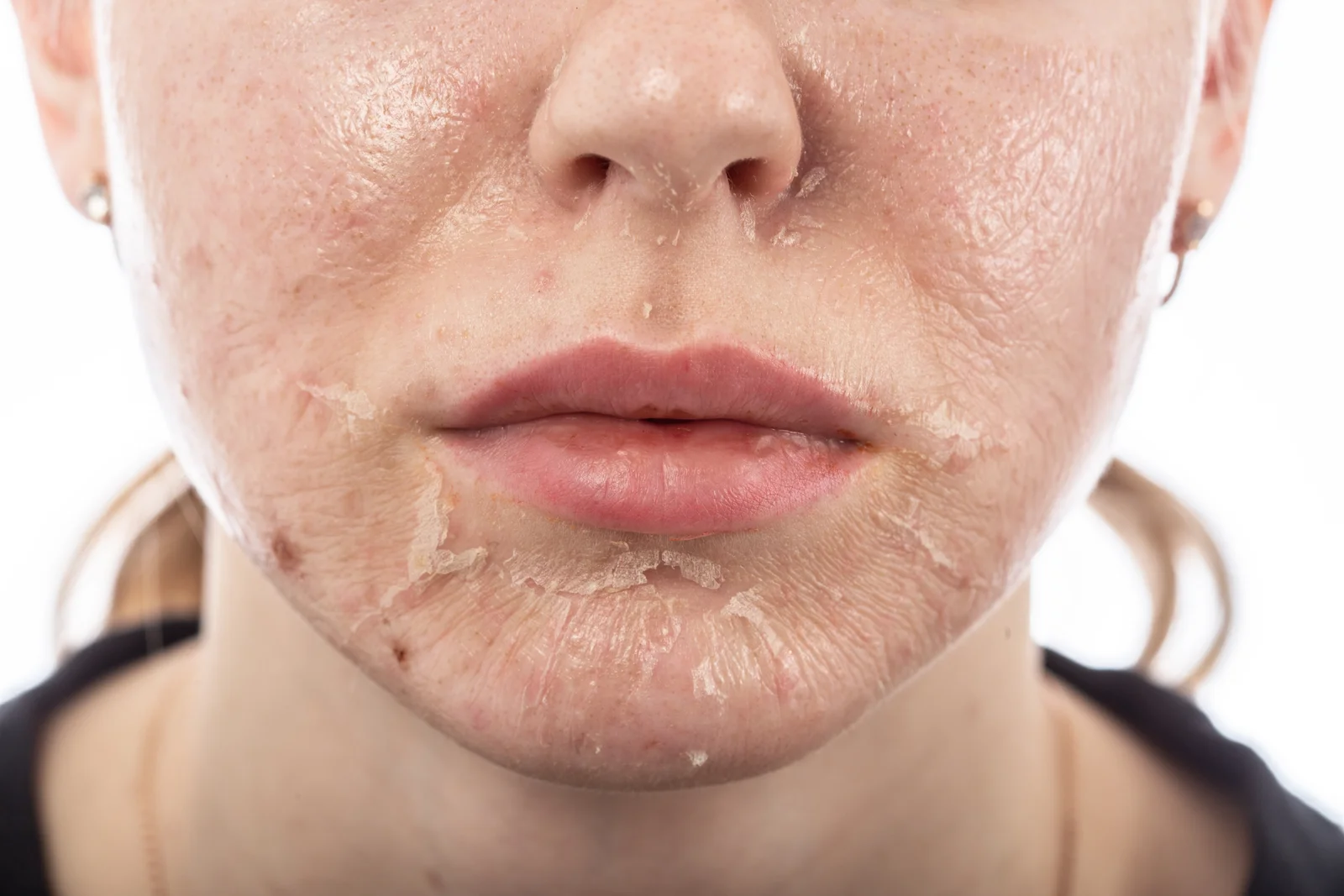THE SCIENCE BEHIND CHEMICAL PEELS